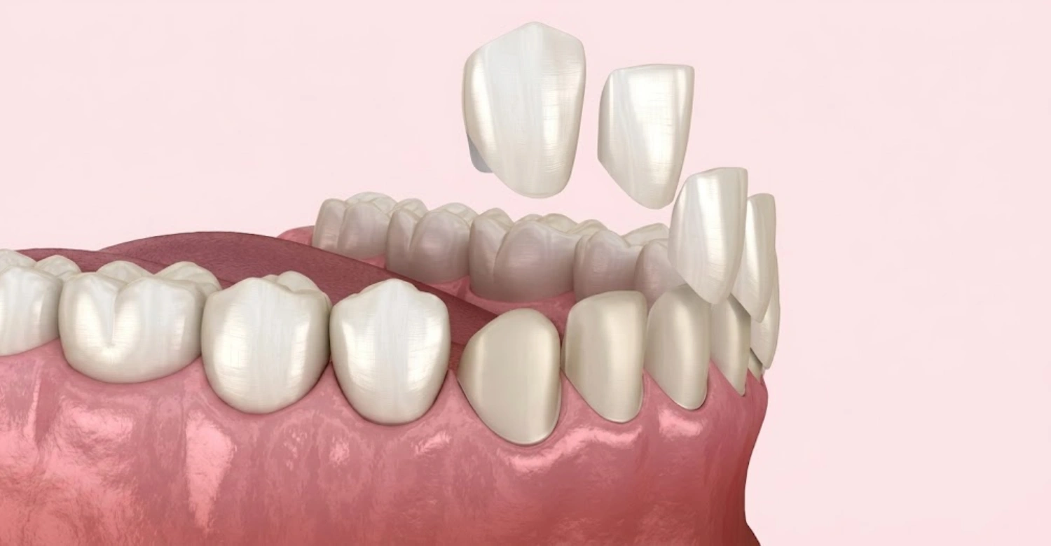 À quoi ressemble un implant dentaire avant la couronne